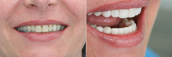 veneers_vorher_nachher